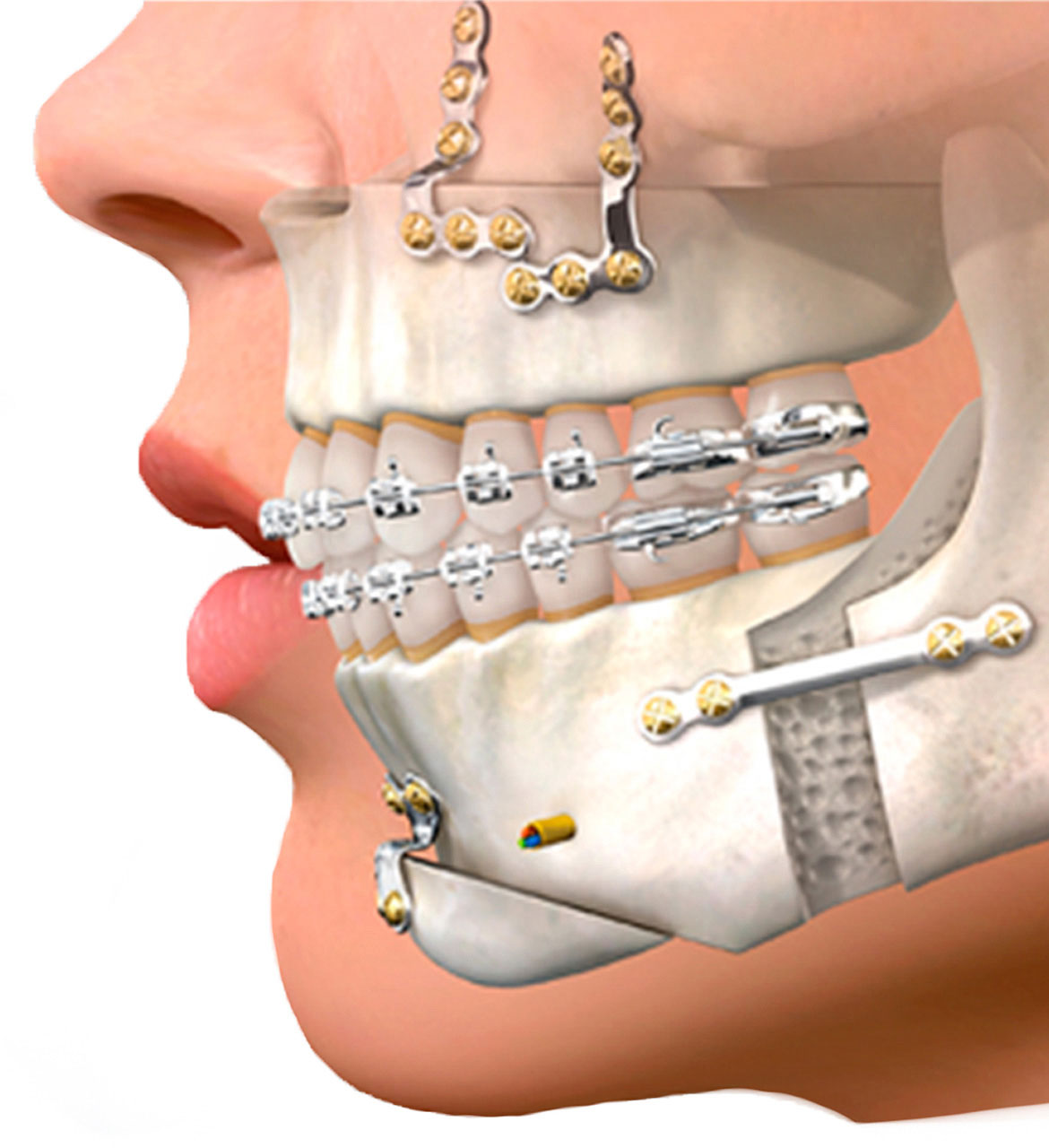 Cirurgia Ortognática